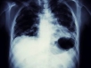 Lung cancer leading cause of cancer deaths